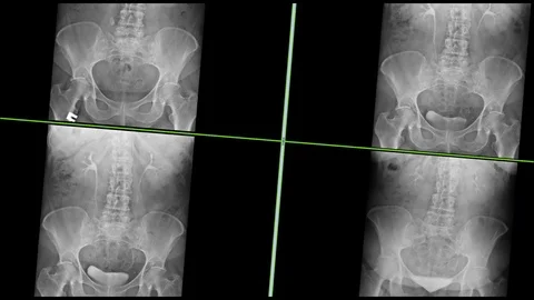 X-rays of the intravenous urography Vídeo Stock 111647669