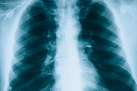 X-rays of lungs. Fluorography. Checking lungs in hospital. Real x-ray human lung Stock Photos