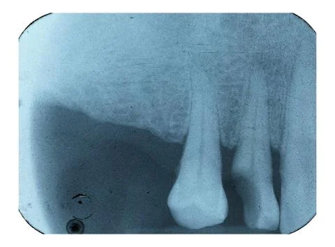 X-rays of a missing tooth Stock Photos