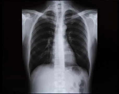 X-rays of the spine and chest. Medicine Stock Photos