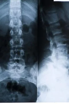 X-rays of the spine Stock Photos
