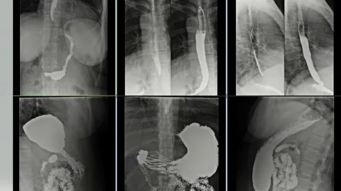X-rays of the stomach with barium 库存影片 111647442