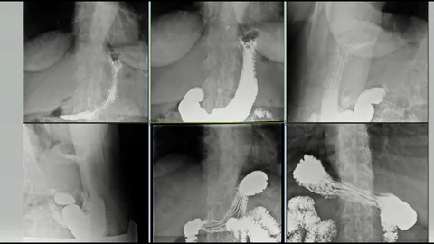 X-rays of the stomach with barium 库存影片 111647470