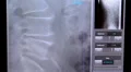 Xray arthritic spine HD 동영상