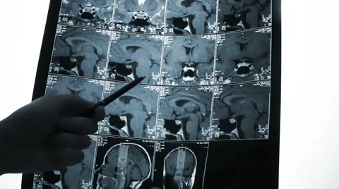 Xray brain 스톡 동영상 47377077