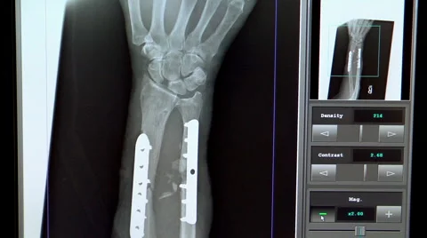 Xray of broken forearm with plate and screws Video stock 1102465