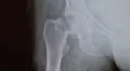 xray broken hip Video HD