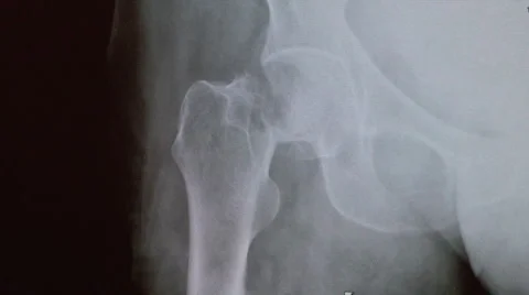Xray broken hip Stock Footage 5434968
