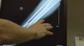 xray of broken leg HD 동영상