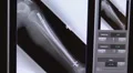 xray of broken lower leg 02 HD Footage