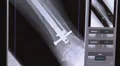 Xray of broken lower leg Video HD