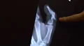 xray of broken thumb 02 HD Footage