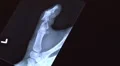 xray of broken thumb HD Footage