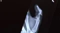 xray of broken thumb zoom out Video HD