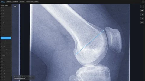 XRay Computer Software With Knee Images Stock Footage 329300186