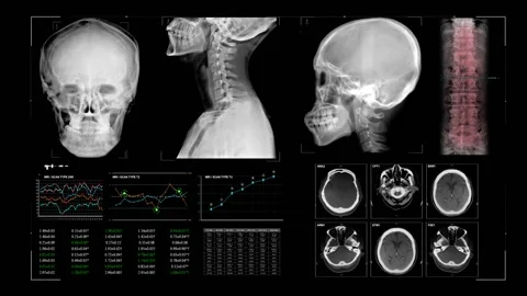 Xray Data Analysis  Video stock 220782300