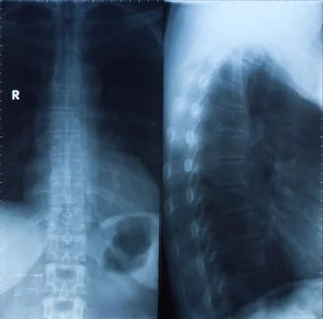 Xray human backbone Stock Photos