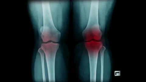 Xray of human knee joint bones with red highlight indicating pain Stock Footage 332870059