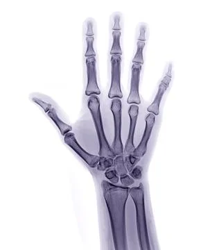 Xray image of both hand AP view isolated on white background  for diagnosti.. Illustrazione stock