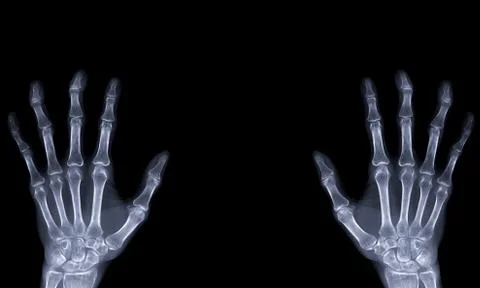 Xray image of both hand AP view isolated on black  background  for diagnostic Stock Photos