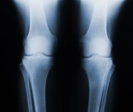 Xray knee joint Stock Photos