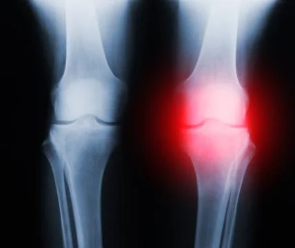 Xray knee joint trauma Stock Illustration