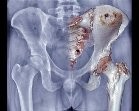 Xray Pelvic Bone ap view  with fusion 3D rendering . Stock Illustration