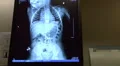 xray of penny in stomach  Vídeos en HD