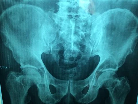 Xray scan of hips Stock Photos