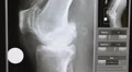 Xray of severely arthritic knee 2 views HD Footage