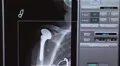 xray shoulder replacement HD Footage