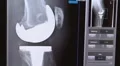 xray of total knee replacement 02 HD Footage