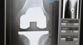 Xray of total knee replacement 2 views Vidéos HD