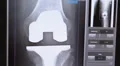 xray total knee replacement Video HD