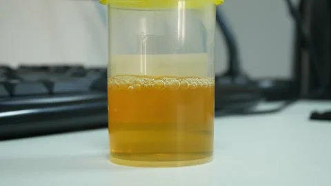 Yellow urine in bottle. Stock Footage 263535520