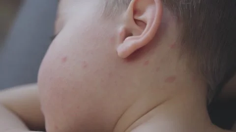 Young boy has chickenpox face captured in close-up covered in red spots Stock Footage 268341293