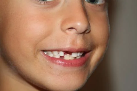 Young boy with missing teeth Stock Photos