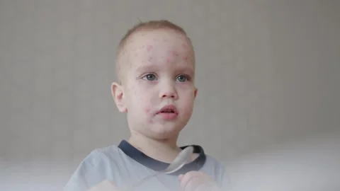 Young boy with redness on face holds spoon in hand. Face expression with redness Stock Footage 281294599