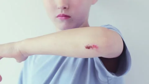 Young boy showing a fresh wound on his elbow Stock Footage 337426355
