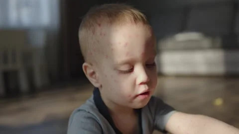 Young boy is suffering from chickenpox face marked with red spots. Despite Video stock 275751033