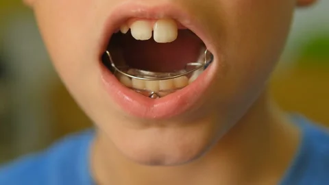 Young child boy use tooth brace for dental healthcare treatment, kids family Stock Footage 220890588