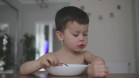 Young child with chickenpox face in red spots eating from plate with spoon Stock Footage 283407594