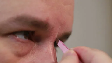 A young european man pulls out eyebrow hairs on the bridge of his nose with twee Видео 170117013