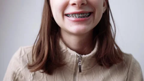 Young girl with abnormal teeth position and correction with metal braces. Stock Footage 262478743