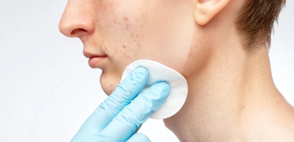 A young guy with problem skin on his face. Photos before and after acne treat Stock Photos