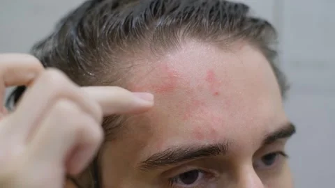 Young guy with redness on his forehead after using shampoo, close-up Stock Footage 283401919