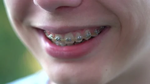 Young kid smiling. White teeth with dental braces. Stock Footage 144476005