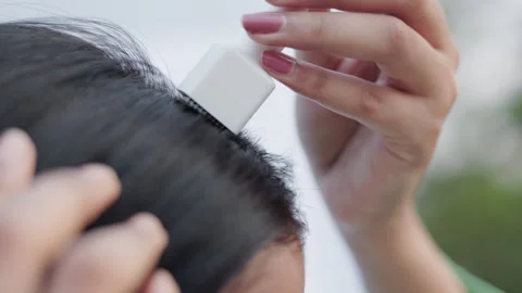 A young lady using derma stamp on head to stimulate hair follicle. Видео 311503910