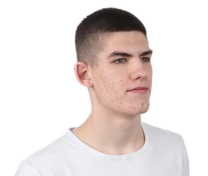 Young man with acne problem isolated on white 스톡 사진