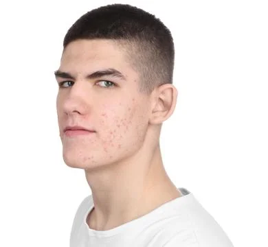 Young man with acne problem isolated on white 스톡 사진